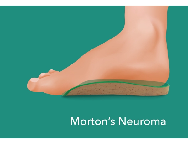 dr scholl's for morton's neuroma